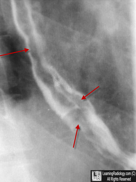 Esophageal Varices